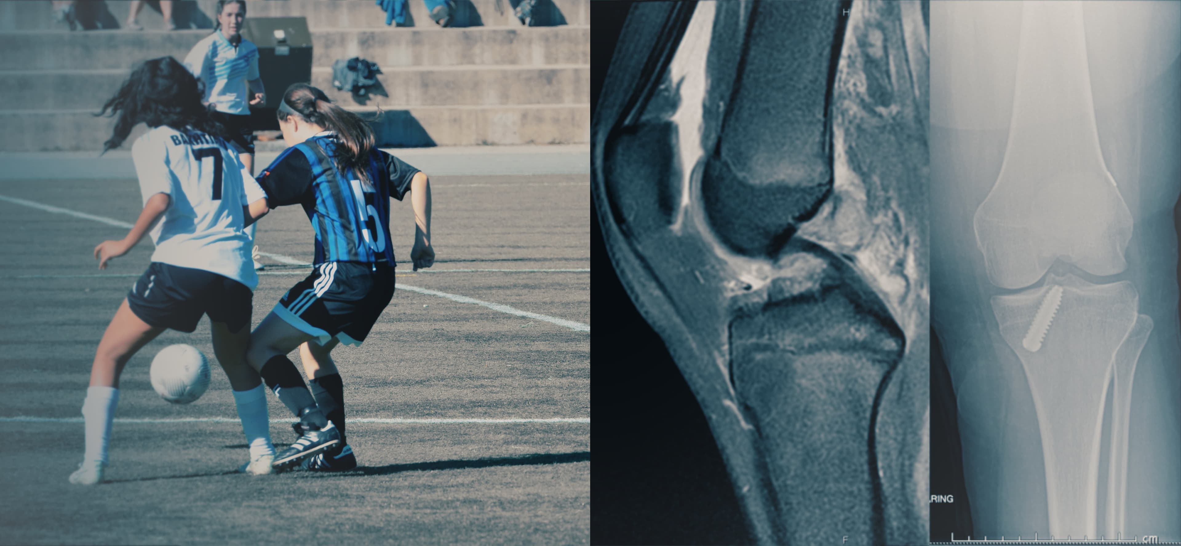 Radiology, Women football, MRI, Knee, X-Ray