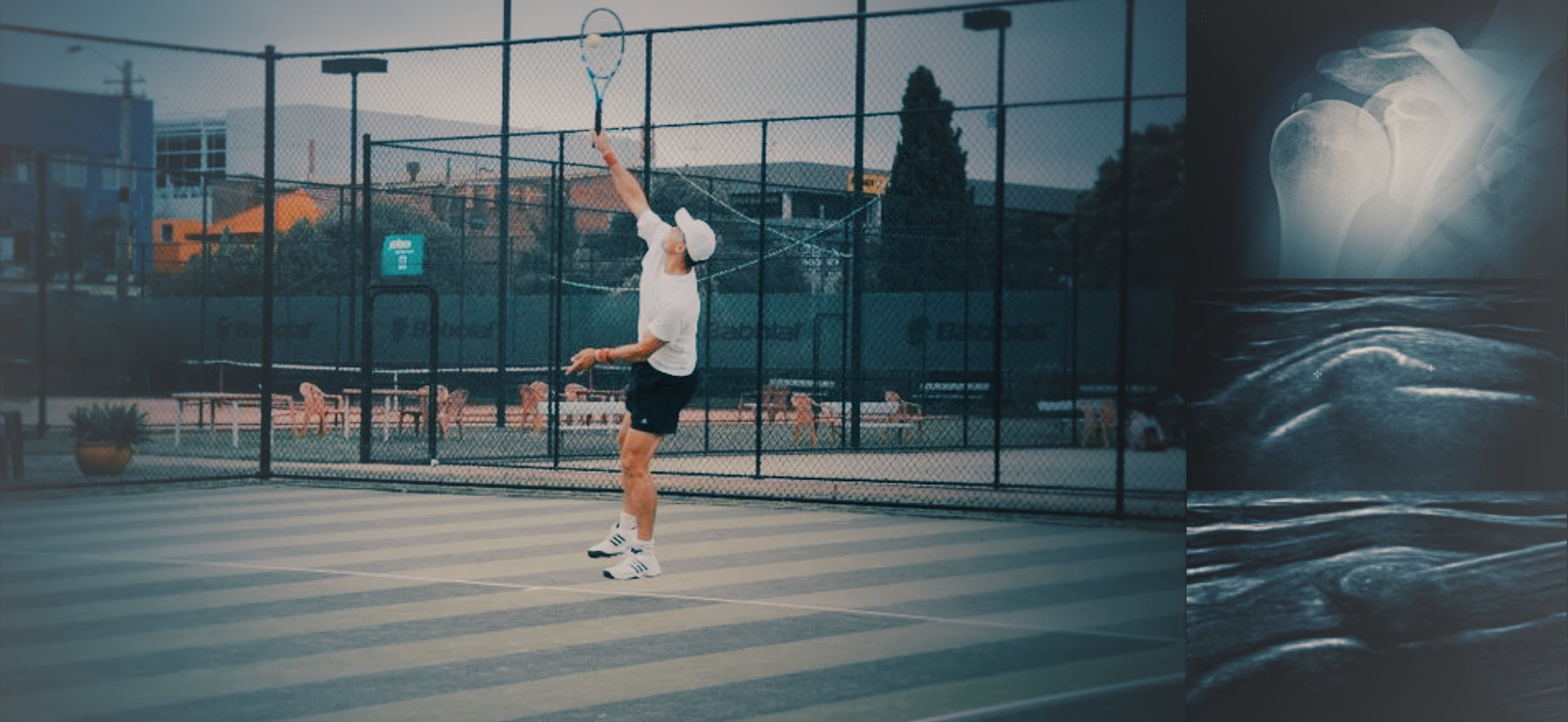 Radiology, Tennis, MRI, Shoulder, X-Ray, Calcific tendinosis