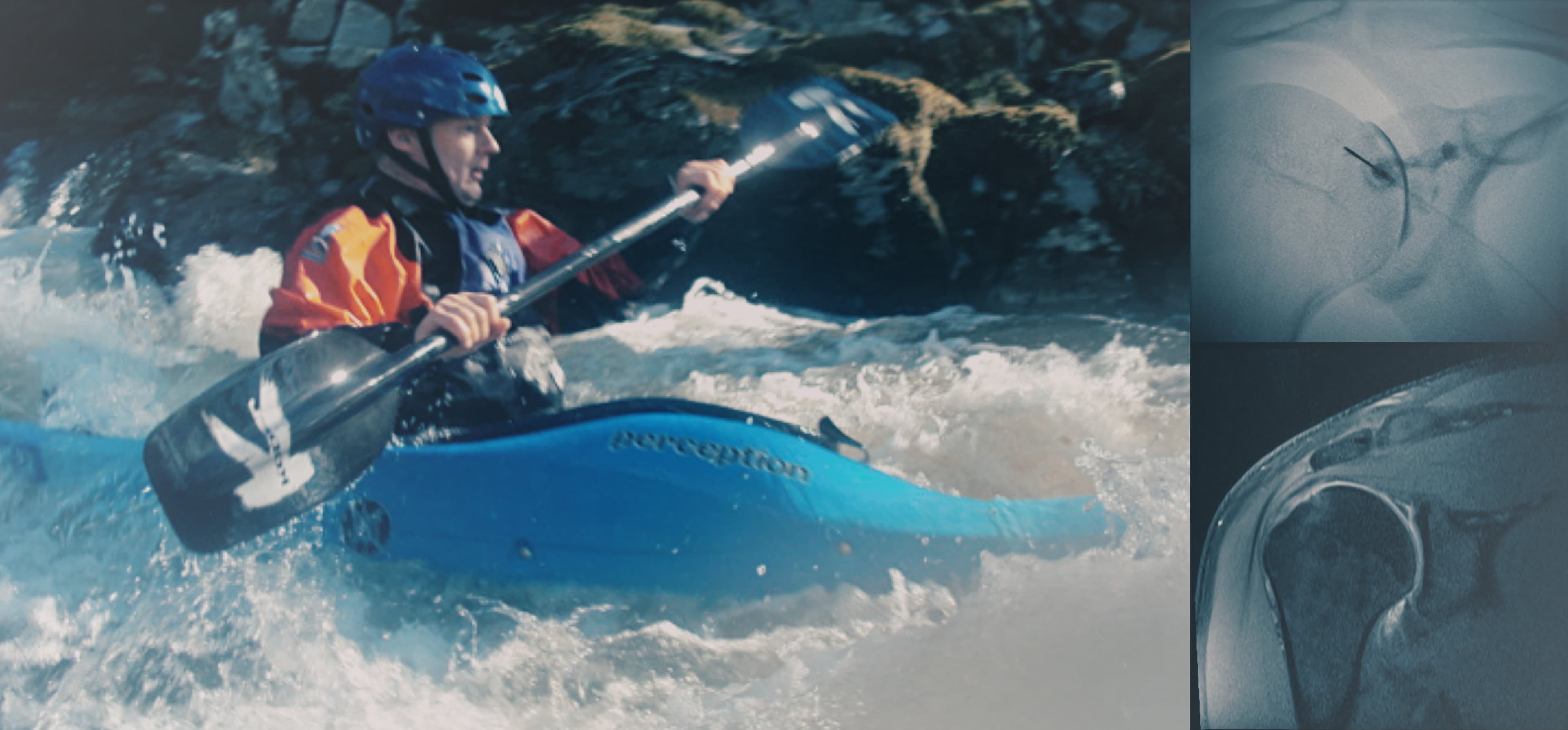 Radiology, Kayak, arthrogram, MRI, Fluoroscopy