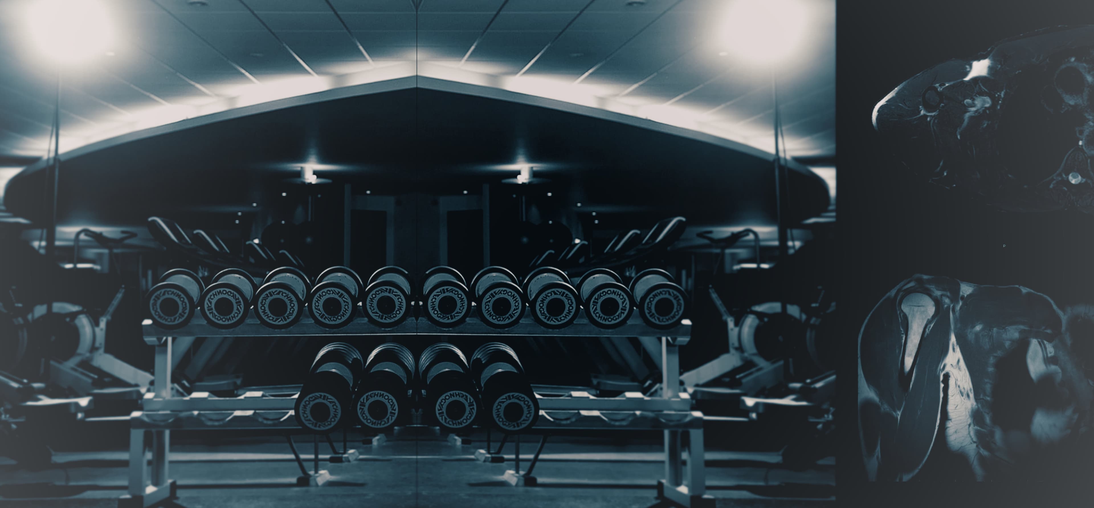 Radiology, Weights, Gyms, fitness, MRI, pectoralis tears.