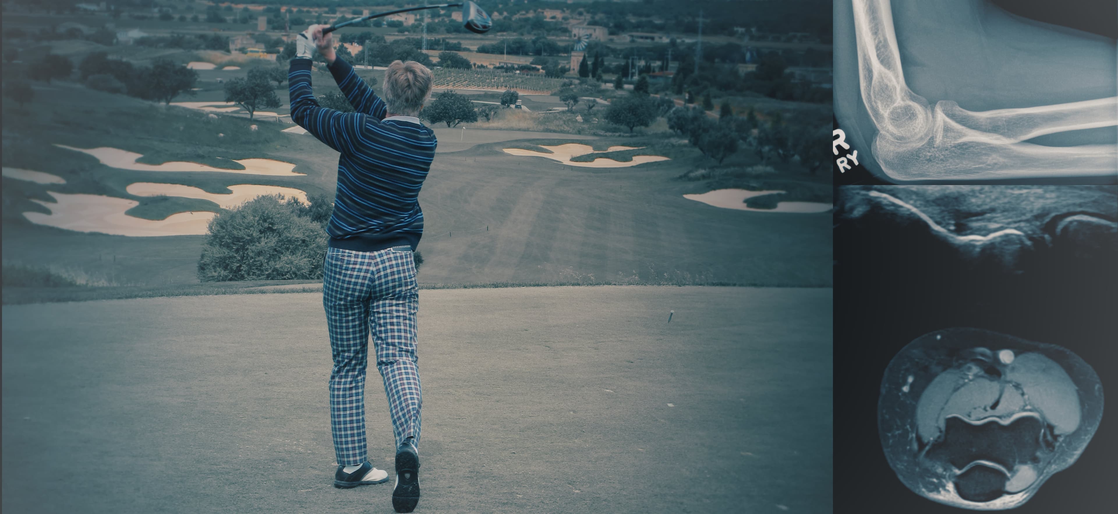 Radiology, golf, elbow x-ray and MRI