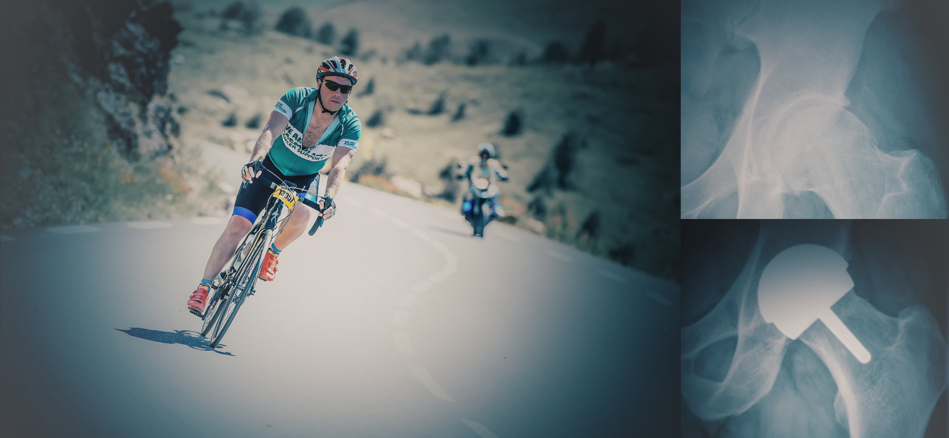 Radiology, Bike, Hip replacement, femoral head resurfacing