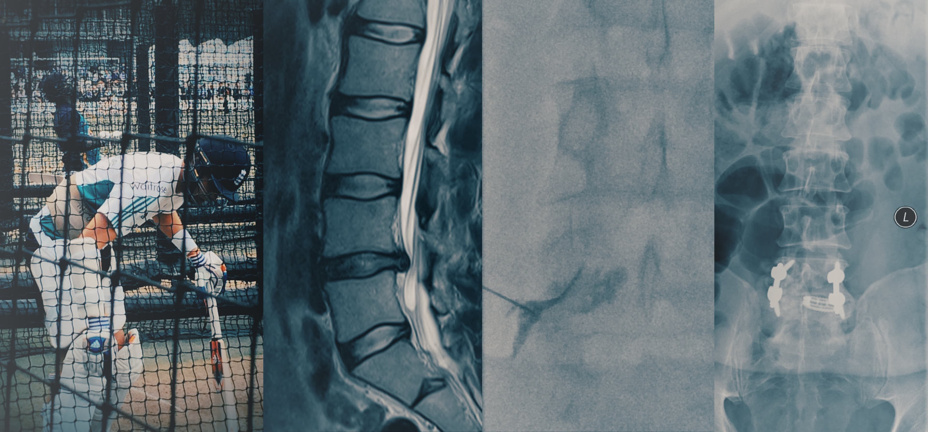Radiology, cricket, X-ray, Nerve root block