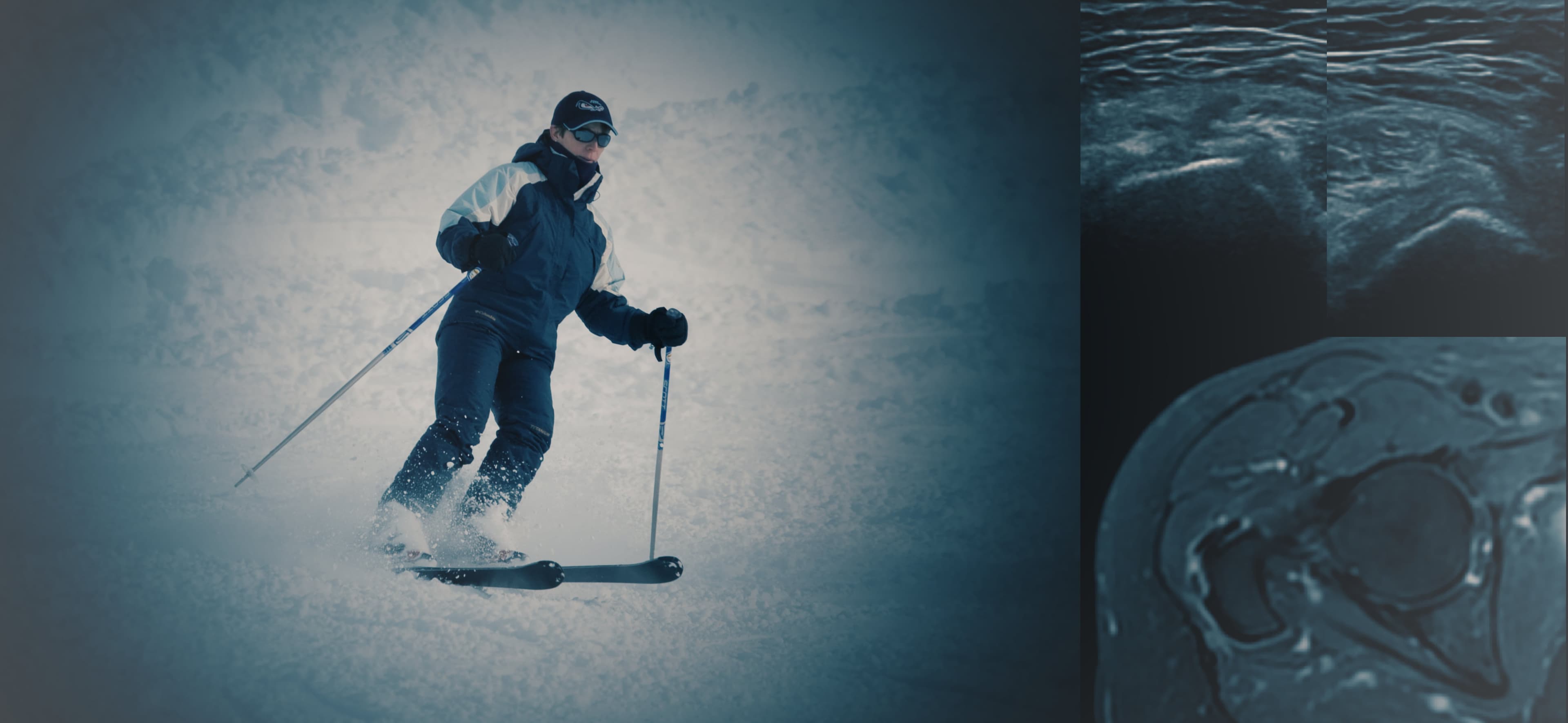 Radiology, Skiing, ultrasound, MRI, Hip