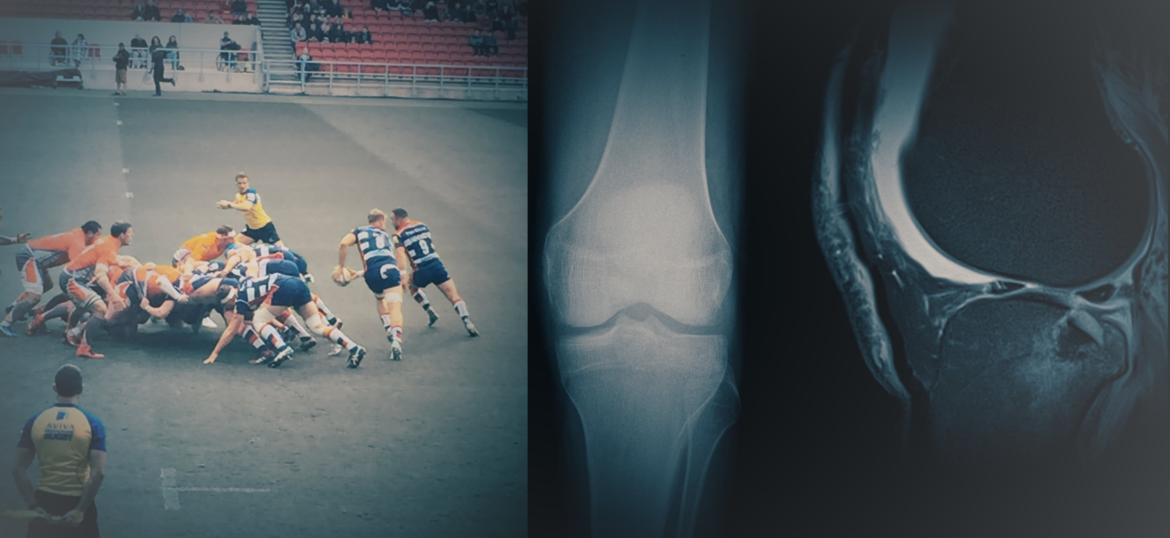 Radiology, Rugby, Knee, X ray, MRI