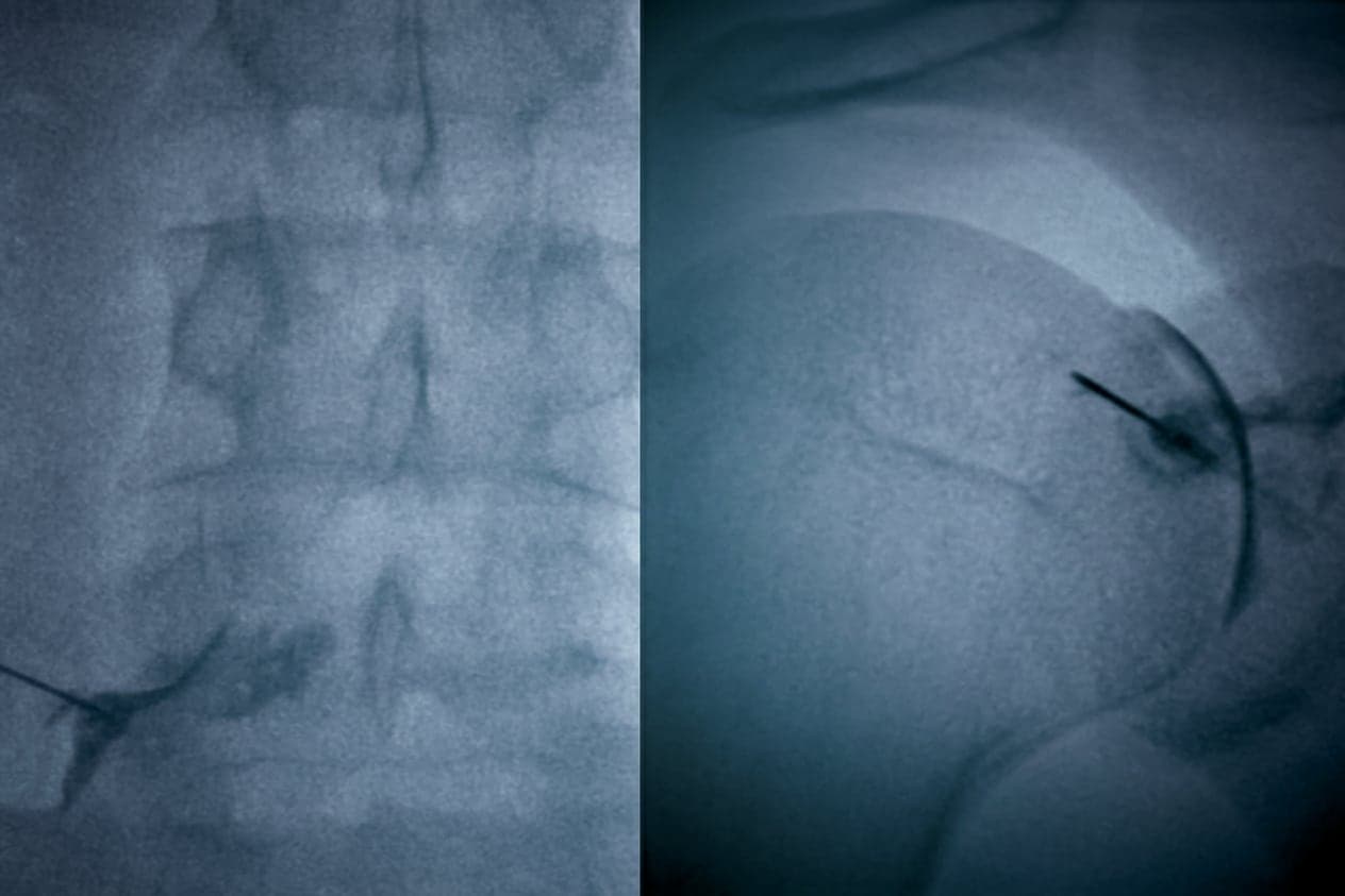 Intevention, nerve root block, arthrogram