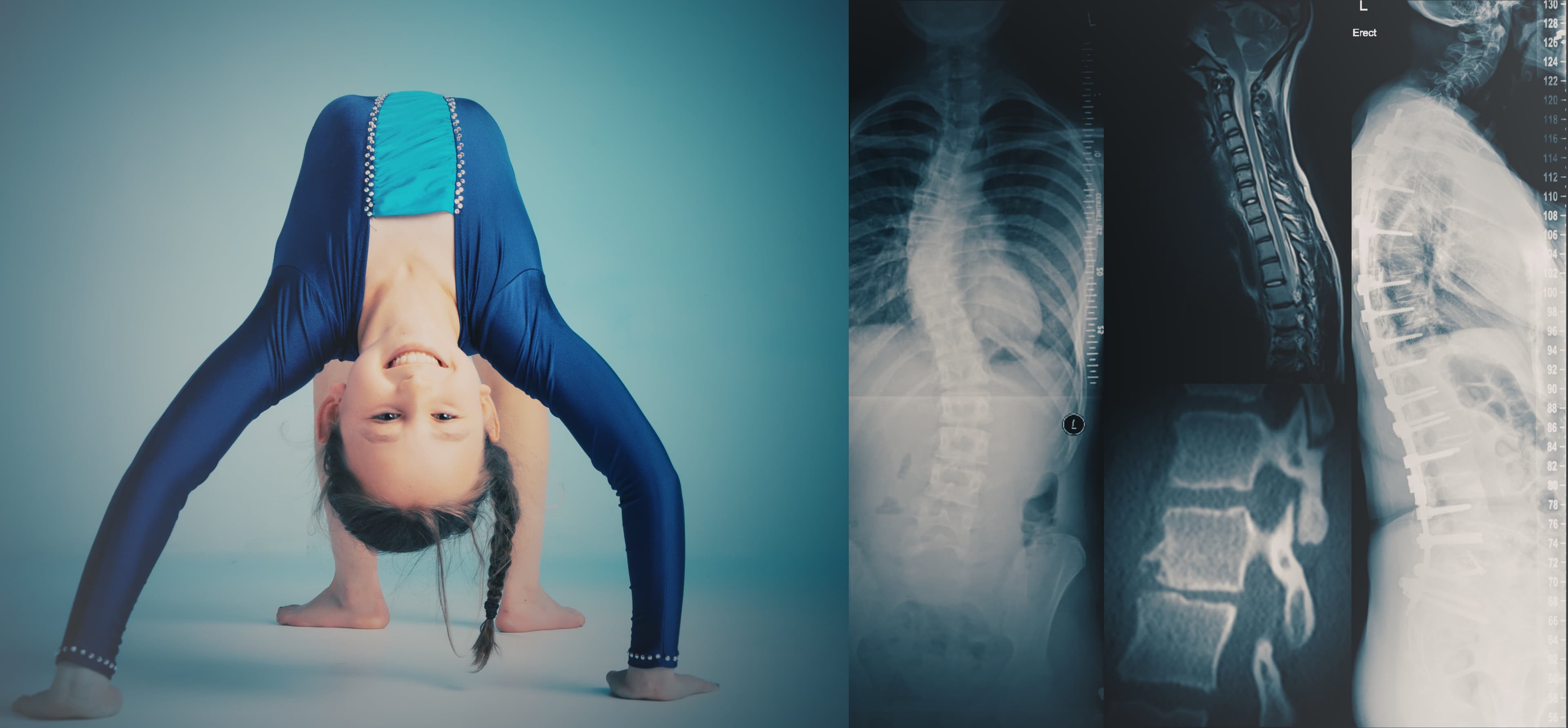 Radiology, Spine, scoliosis, Spinal fixation