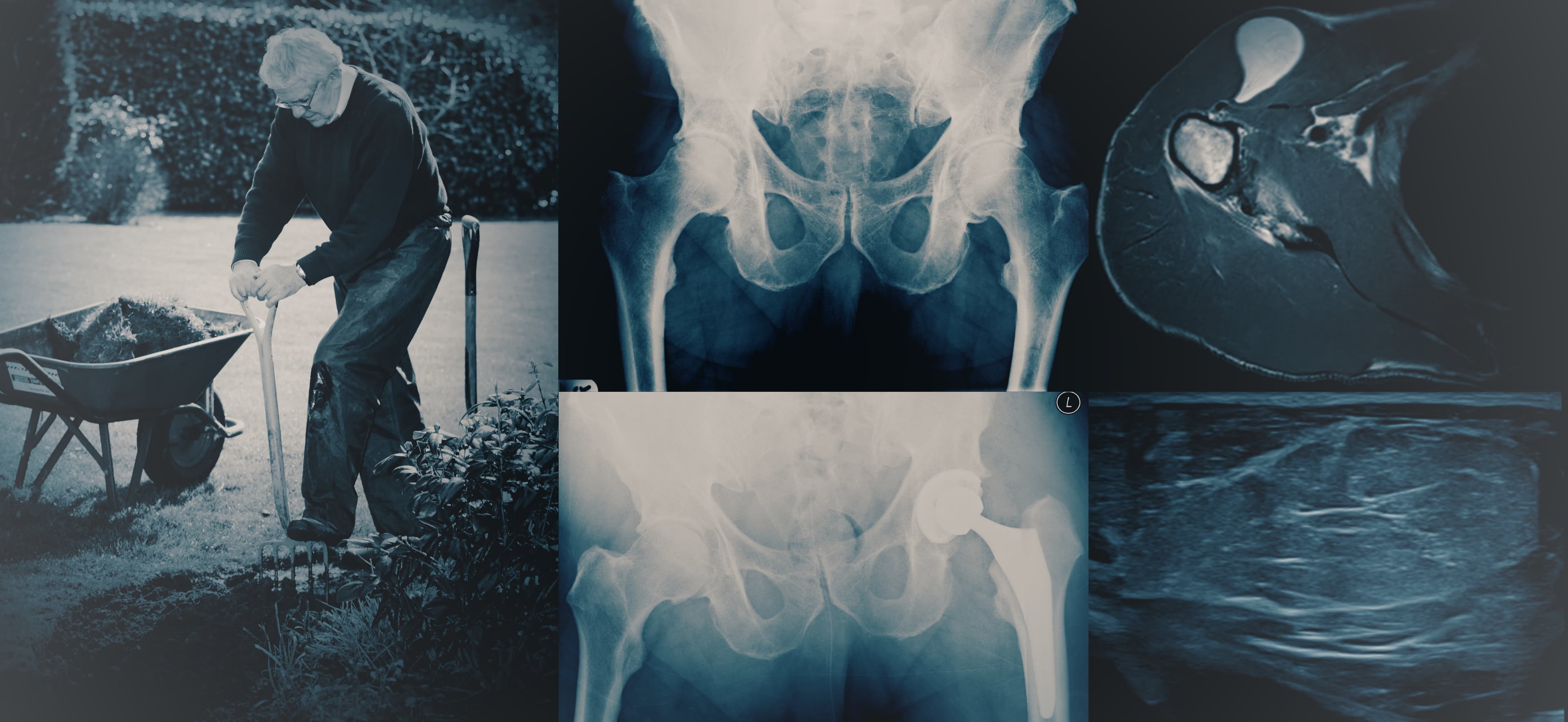 Radiology, Gardening, Hip, Osteoarthritis, Hip prothesis, Hip replacement